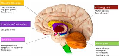 Editorial: Pediatric diencephalic tumors: a constellation of entities and management modalities